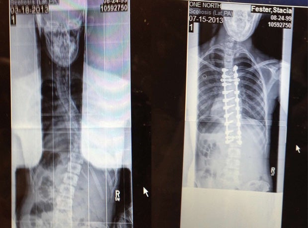 Stacia Fester's spine (right) was straightened with two titanium rods and 20 screws, helping to reverse some of the effects of idiopathic thoracic scoliosis (left).